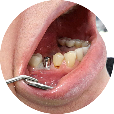Имплант 45 зуба